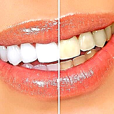 دانت سفید کرنے کی تصویر آن لائن